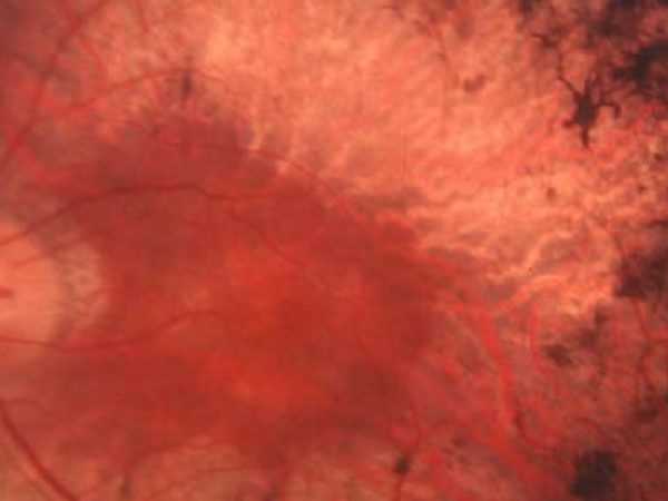 Casi el 90% de las enfermedades raras oculares son de origen genético