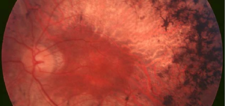 Casi el 90% de las enfermedades raras oculares son de origen genético