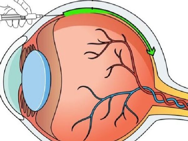 El tratamiento utiliza una pequeña aguja para inyectar virus inofensivos, genéticamente modificados, en el espacio supracoroideo del ojo. GRÁFICO: Universidad Johns Hopkins