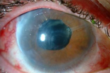 California presenta un proyecto de ley para que los ópticos practiquen ciertas cirugías oculares