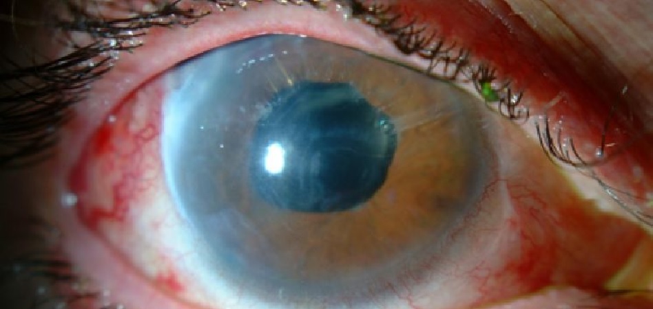 El Consejo General de Ópticos advierte del peligro del glaucoma en la sociedad