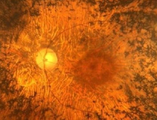 Ojo con retinosis pigmentaria