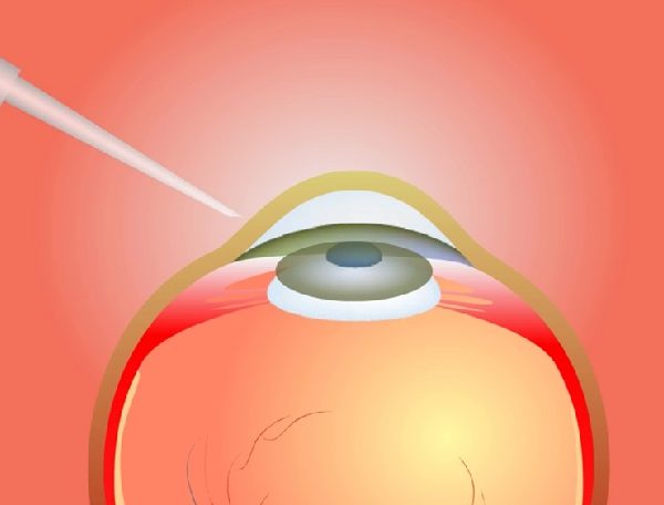 El Hospital Doce de Octubre administrará la primera terapia génica aprobada en España para el tratamiento de un tipo concreto de distrofia hereditaria de la retina que afecta a niños y adultos jóvenes, producida por la mutación del gen RPE65