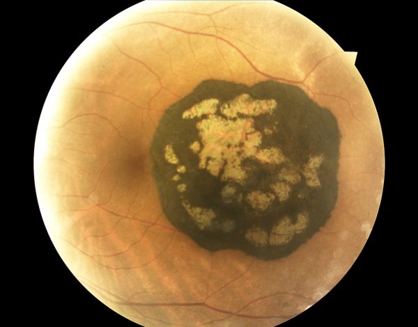 Orduna e-Learning y Cione anuncian los ganadores del Concurso de Fotografía para Ópticos- Optometristas