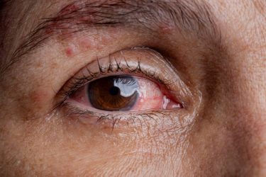 Un tratamiento antiviral prolongado durante un año puede ayudar a prevenir el deterioro de la visión asociado con el herpes zóster ocular, según un nuevo estudio realizado por investigadores de la Facultad de Medicina Perelman de la Universidad de Pensilvania y la Facultad de Medicina Grossman de la Universidad de Nueva York.