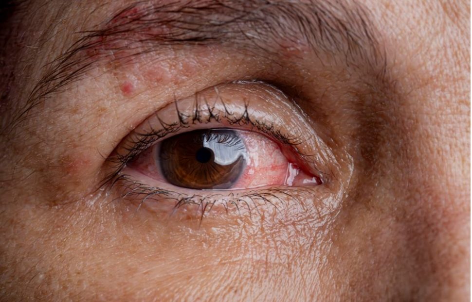 Un tratamiento antiviral prolongado durante un año puede ayudar a prevenir el deterioro de la visión asociado con el herpes zóster ocular, según un nuevo estudio realizado por investigadores de la Facultad de Medicina Perelman de la Universidad de Pensilvania y la Facultad de Medicina Grossman de la Universidad de Nueva York.